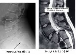 Trượt đốt sống - Hình ảnh minh họa